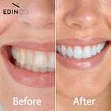 Before and after photos showing teeth whitening results for a smile that promotes relax sleep aid