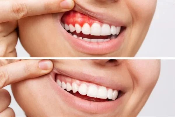Best Toothpaste for Gingivitis Prevention (UK) - Edinco