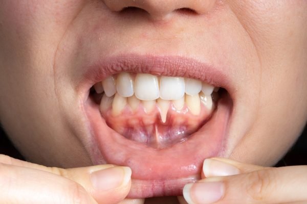 Best Toothpaste for Painful Gums When Brushing - Edinco