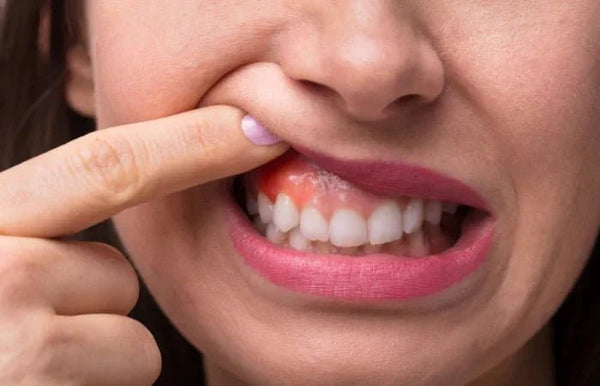 Gum Inflammation Care: Natural Toothpaste Ingredients - Edinco