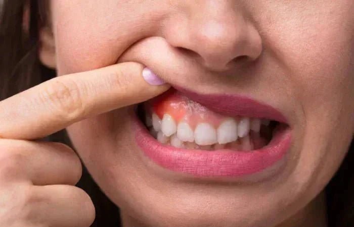 Natural Toothpaste for Inflamed Gums & Bleeding Care (UK) – Edinco