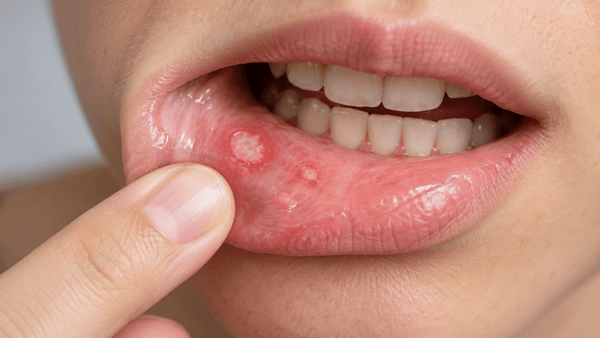Close-up of a mouth with visible ulcers on the inner lower lip, showing red and white sores associated with mouth ulcers.