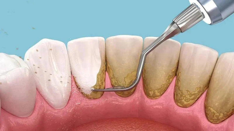 Tartar Control Toothpaste: Expert Recommendations - Edinco
