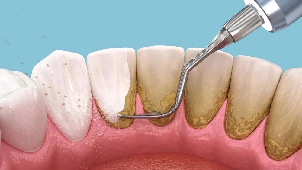Tartar Control Toothpaste: Expert Recommendations - Edinco