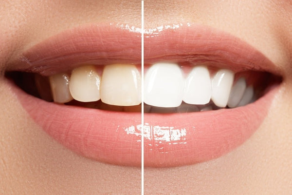 Edinco natural charcoal toothpaste lifting yellow teeth surface stains safely.