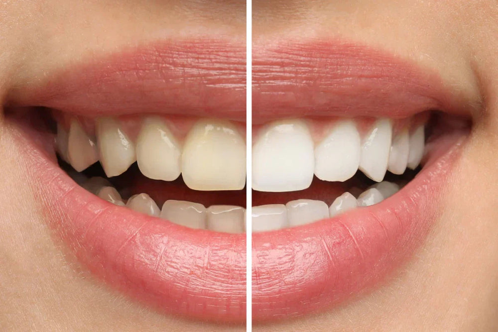 What Is the Best Toothpaste to Remove Coffee Stains in the UK?