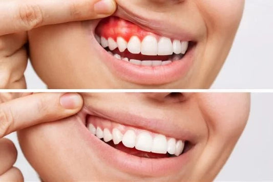 What’s the Best Toothpaste for Swollen or Bleeding Gums? - Edinco