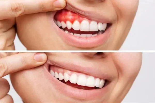 What’s the Best Toothpaste for Swollen or Bleeding Gums? - Edinco
