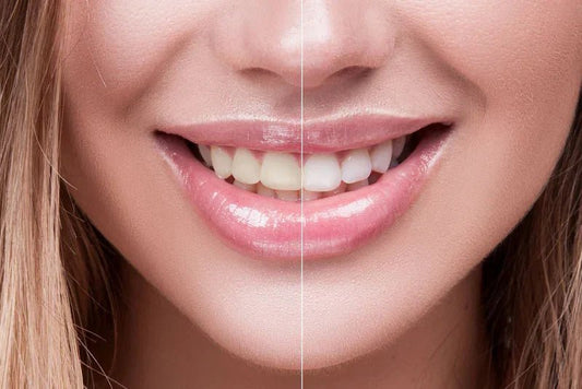 Which Is Better for Your Teeth: Charcoal Toothpaste or Non-Abrasive Whitening? - Edinco