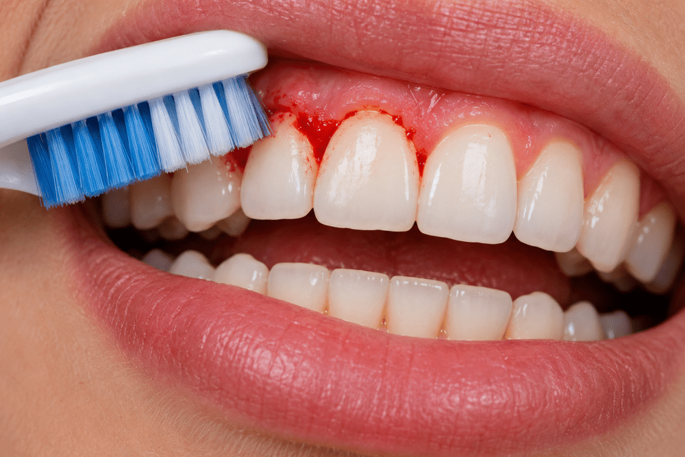Close-up of a toothbrush gently brushing along red, bleeding gums and clean teeth, illustrating gum irritation during brushing.